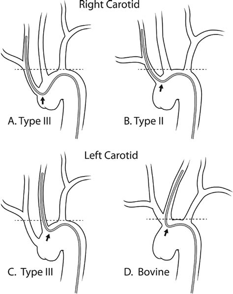 Schematic examples of unfavorable aortic arch anatomy. (A) Type III... | Download Scientific Diagram