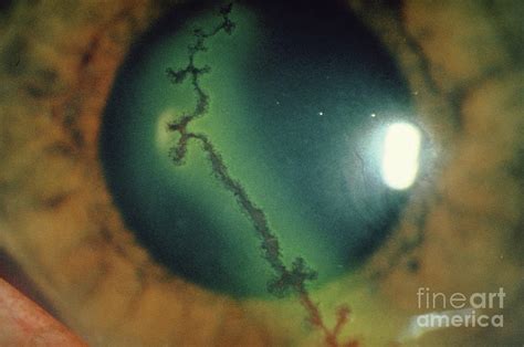 Dendritic Ulcer (herpes Simplex) On Cornea Of Eye by Argentum/science Photo Library