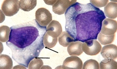 Mononucleosi: quali esami di laboratorio eseguire? | Pediatria e Medicina per Neonati e Bambini ...