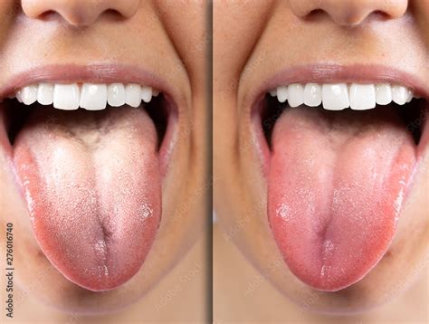 A before and after view of on the tongue of a Caucasian girl, she sticks her tongue out to ...