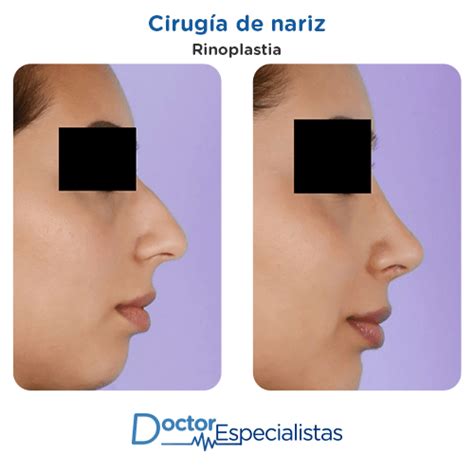 Otorrinolaringologos Para Cirugia de Nariz | Doctor Especialistas