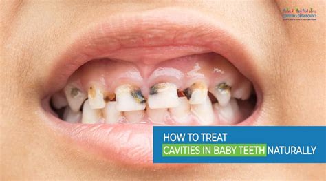 How to Treat Cavities in Baby Teeth Naturally: Risk & Remedies