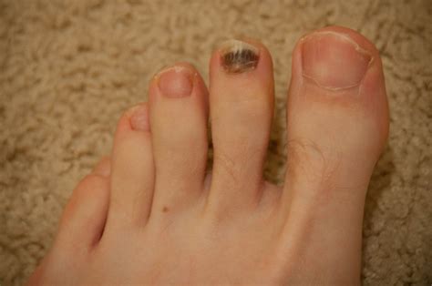 melanoma on toenail - pictures, photos