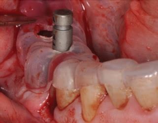 Surgical Guide Techniques for Dental Implant Placement