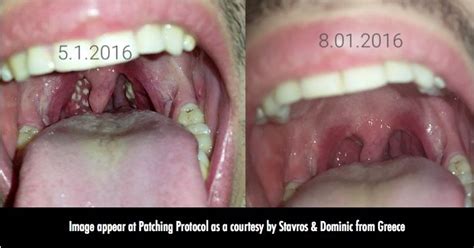 LifeWave Patches and Tonsils Infection – Lifewave Patches Protocols