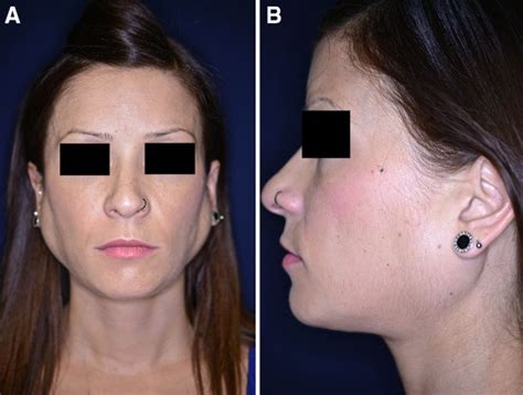 Parotid Gland Swelling Eating Disorders