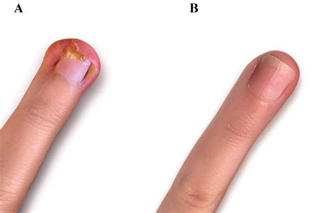 Stress Strip Nail : While everyone knows that stress can take a toll on a person physically and ...