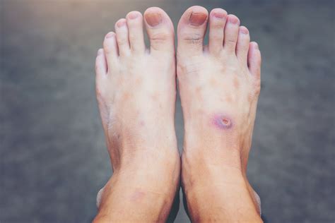 Should You Worry About a Diabetic Foot Ulcer? + Prevention and ...