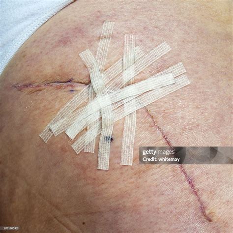 Healing Hip Replacement Wound With Steristrips High-Res Stock Photo - Getty Images