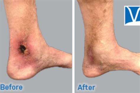 Ankle Discoloration - Inovia Vein Specialty Centers | Northwest Vein Treatment Clinics