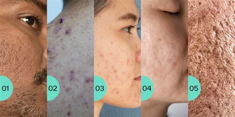 Everything You Need To Know About Acne Scarring - SkinLab