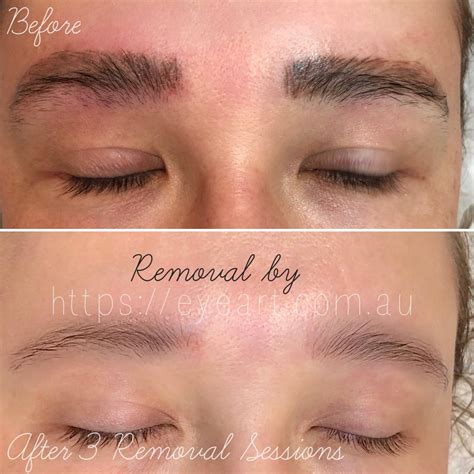 Eyebrow Semi Permanent Makeup Removal | Saubhaya Makeup