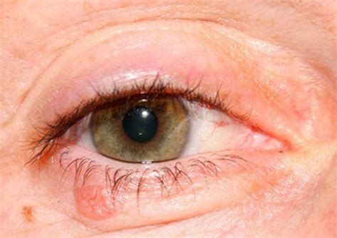 Eyelid Cancer: Biopsy - The Eyelid Institute