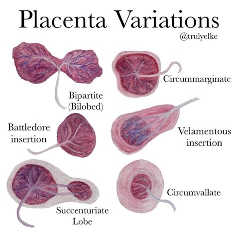 battledore placenta - Google Search | Midwifery student, Obstetrics and gynaecology, Placenta