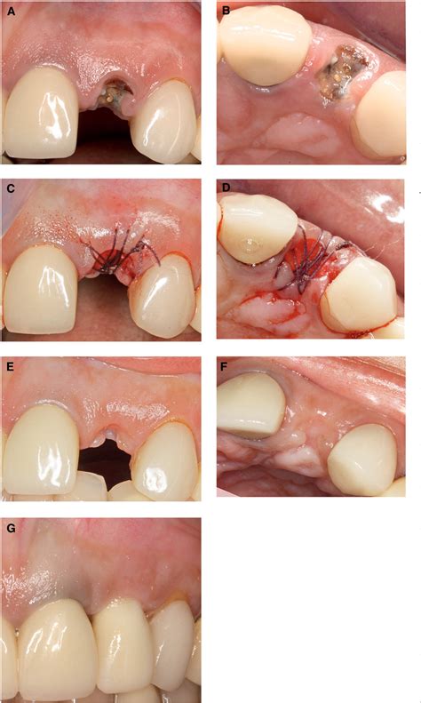 Tooth Extraction Bone Graft Healing Stages Pics | SexiezPicz Web Porn