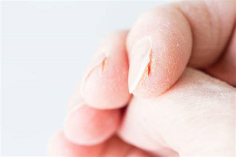 Dry Cracked Hands Stock Photos, Pictures & Royalty-Free Images - iStock