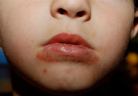 Why Do I Have A Red Spot Under My Lip | Sitelip.org