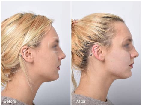 The Easiest Way To Get Rid of Turkey Neck Without Surgery - Belcourt ...