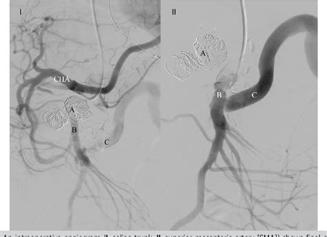 Figure 4 from A hybrid procedure for middle colic artery aneurysm complicated by chronic ...