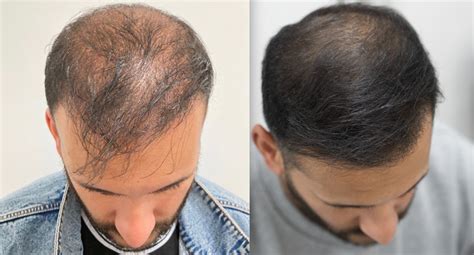 Irfan’s Laser Hair Growth Treatment Before-And-After Photos! Este Medical