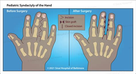 Syndactyly | Baltimore, MD | International Center for Limb Lengthening