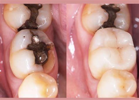 Black Stains on Teeth: Causes, Remedies and Treatment