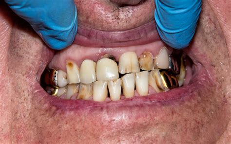 Rotten Teeth Extraction in HIV Patients | yapmt.org