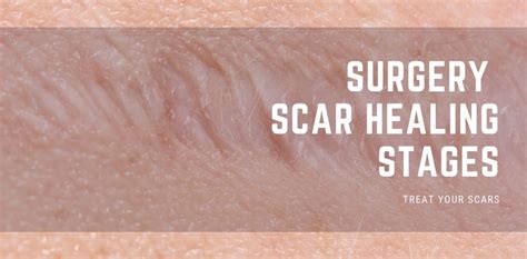 Surgery Scar Healing Stages - Treat Your Scars