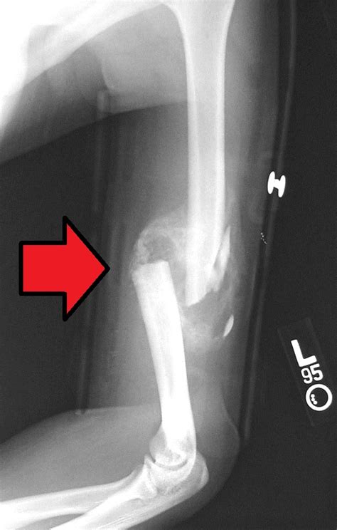 Humerus fracture - Wikipedia