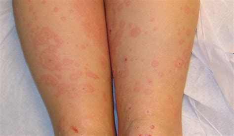 Stevens Johnson Syndrome Mild Rash