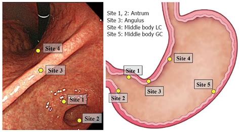 Can endoscopic atrophy predict histological atrophy? Historical study ...