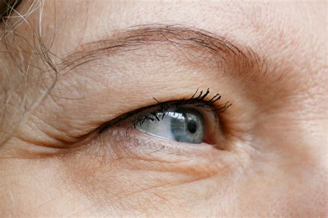Ptosis Causes and Treatment | Fort Lauderdale Eye Institute