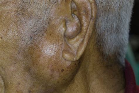 Parotid gland tumor – causes, side effects and treatments at NaturalPedia.com