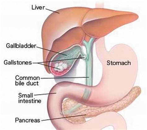 Acute Cholecystitis: Recommended Diet Plan and Drugs