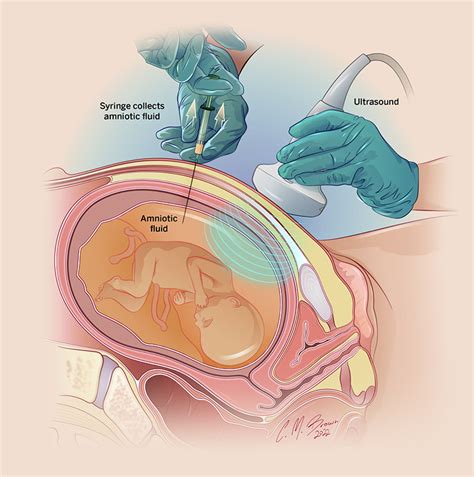 Amniocentesis | Riley Children's Health