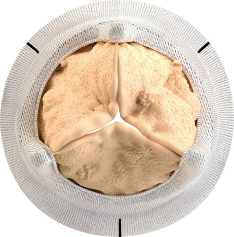 Aortic-Bioprosthetic-Valve -topview-calcification - Heart Valve Choice