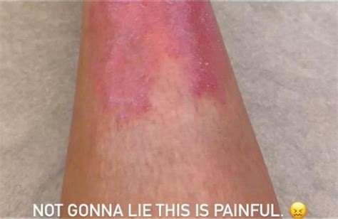 Kim Kardashian Shares 'Painful' Psoriasis Update