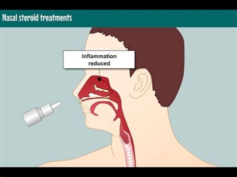 Nasal steroid treatments - YouTube