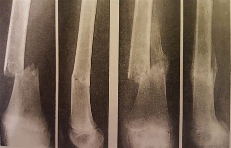 Pathology of Fractures and Fracture Healing - Momentum