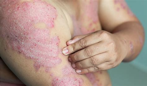 Low-Cost Antibacterial Treatment Regimen to Prevent Acute Radiation Dermatitis: Study at ...