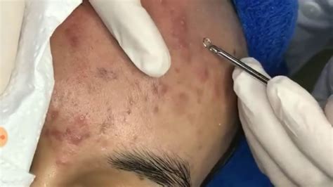 LARGE Blackheads Removal - Satisfying Blackhead 2019 (Part 10) - YouTube