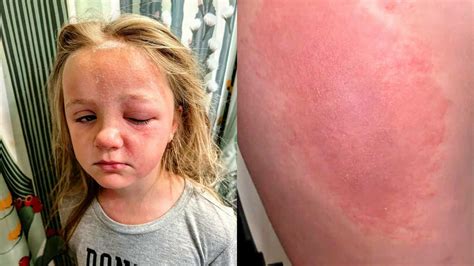 ‘It looks like a harmless weed.’: Mom warns of poison hemlock after daughter suffers severe ...