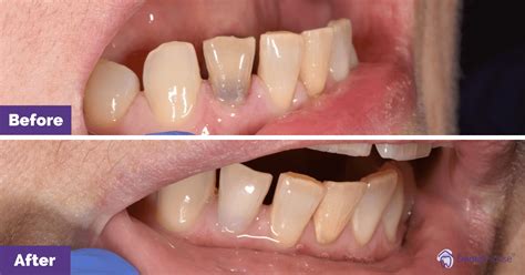 Internal Bleaching in Dental House Group - Melbourne Dental House