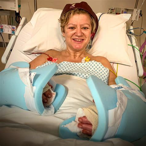 Scots mum - who had parts of all four limbs amputated to save life after pneumonia and sepsis ...