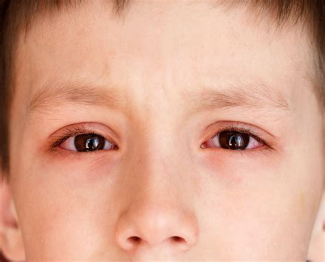 Pink Eye (Conjunctivitis): Causes, Symptoms & Treatment | Live Science