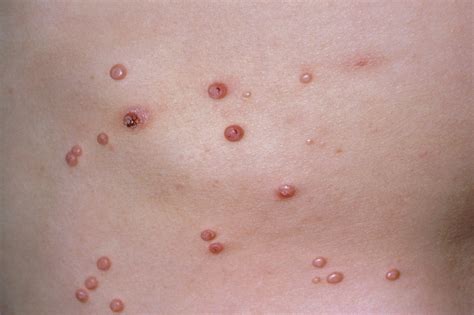 Molluscum contagiosum - NHS