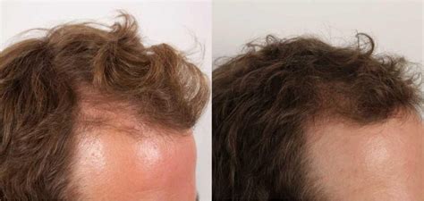 Nutrafol-before-and-after-images- | Reactive Hair