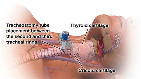 Percutaneous Tracheostomy | NEJM