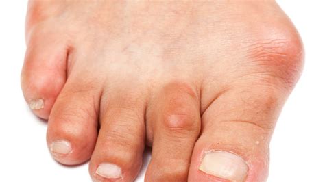 Facts About Bunions You Should Know - Dr Sami - Podiatrist DubaiDr Sami – Podiatrist Dubai ...