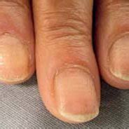 Cupuliform depressions on fingernails and some linear hemorrhages ...
